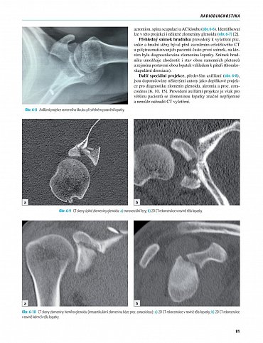 Náhled Zlomeniny lopatky