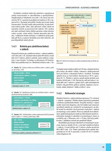Náhled Spondyloartritidy