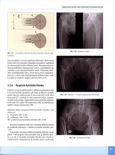 Náhled Artroskopie kyčelního kloubu