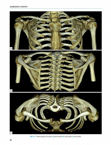 Náhled Zlomeniny lopatky