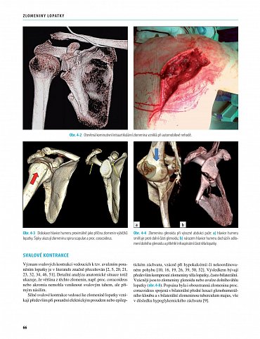 Náhled Zlomeniny lopatky