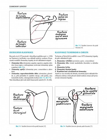 Náhled Zlomeniny lopatky