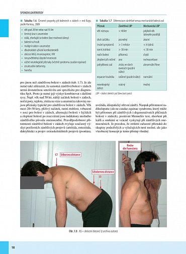 Náhled Spondyloartritidy