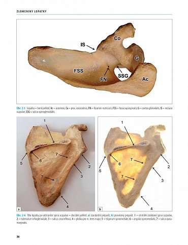 Náhled Zlomeniny lopatky
