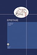 Epistaxe