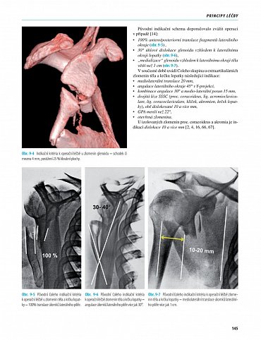 Náhled Zlomeniny lopatky