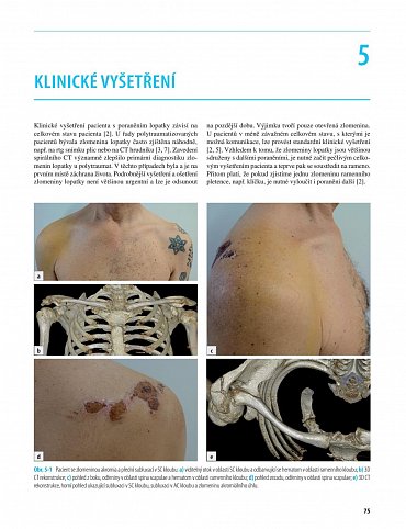 Náhled Zlomeniny lopatky