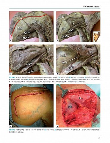 Náhled Zlomeniny lopatky