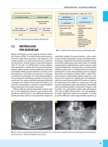 Náhled Spondyloartritidy