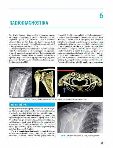 Náhled Zlomeniny lopatky