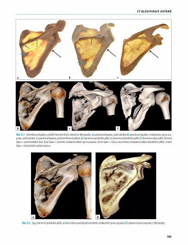 Náhled Zlomeniny lopatky