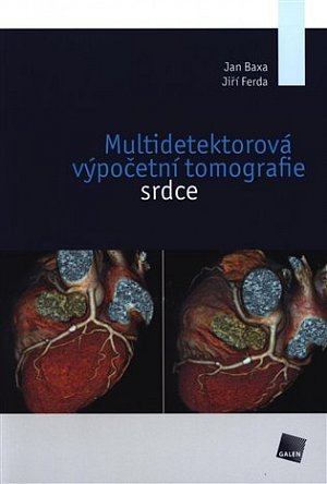 Multidetektorová výpočetní tomografie srdce