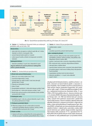 Náhled Spondyloartritidy
