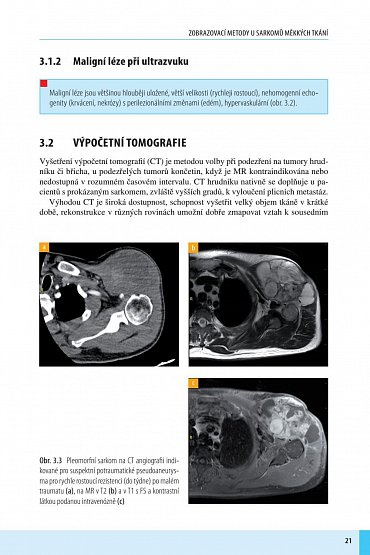 Náhled Sarkomy měkkých tkání