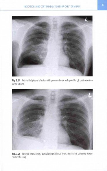 Náhled Thoracic Drainage / A Step-by-Step Guide